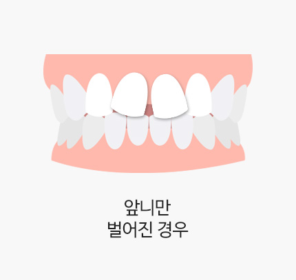 앞니만 벌어진 경우