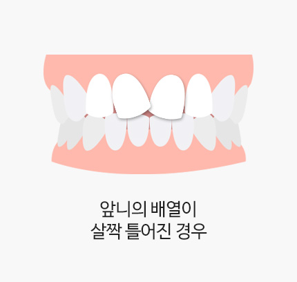 앞니의 배열이 살짝 틀어진 경우