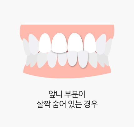 앞니 부분이 살짝 숨어 있는 경우